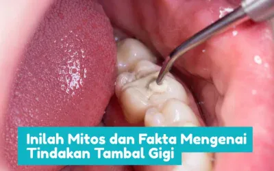 Inilah Mitos dan Fakta Mengenai Tindakan Tambal Gigi