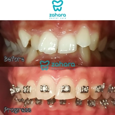 layanan klinik gigi pemasangan kawat gigi dari zahara dental care palembang