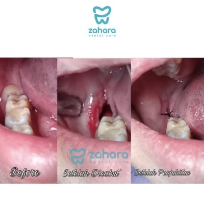 layanan operasi gigi bungsu dari klinik gigi zahara dental care palembang