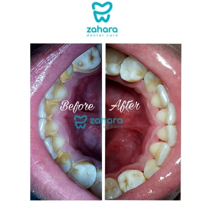 layanan scaling gigi dari klinik gigi zahara dental care palembang