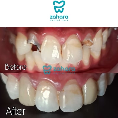 layanan veneer gigi dari klinik gigi zahara dental care palembang