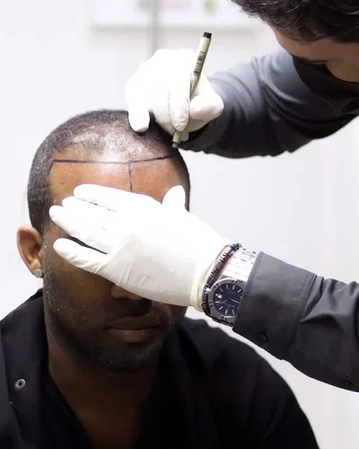 Afro Hair Transplant in Turkey, Vera Clinic