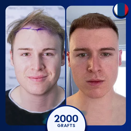 2000 grafts male hair transplant in Turkey before after