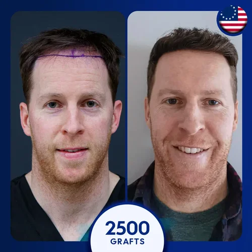 2000 grafts male hair transplant in Turkey before after