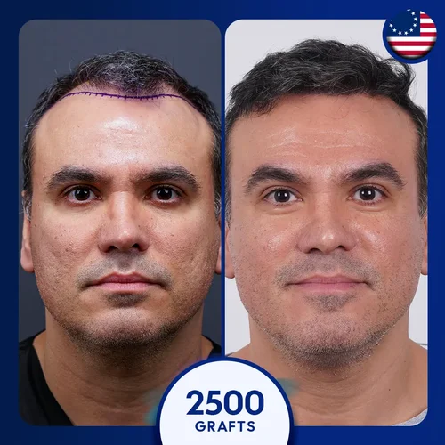 2500 grafts male hair transplant in Turkey before after