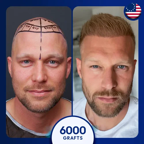 Sapphire FUE Hair Transplant Turkey Before and After