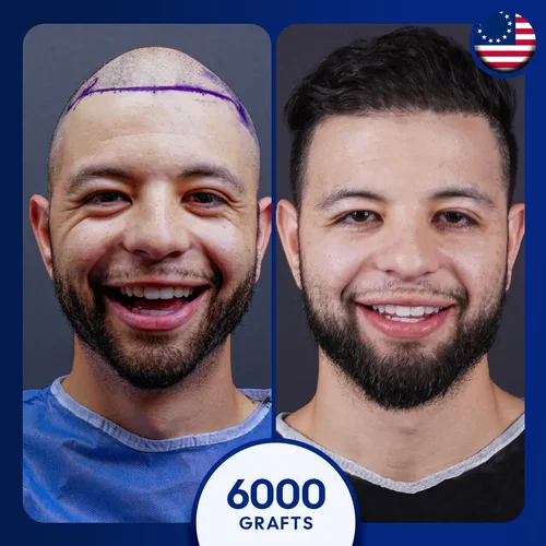 Sapphire FUE Hair Transplant Turkey Before and After