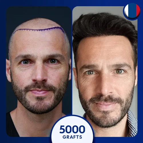 Sapphire FUE Hair Transplant Turkey Before and After