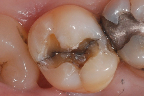 Cracked molar 