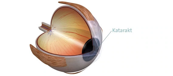 Katarakt (Grauer Star) Erklärung, Ursachen, Operation Augen