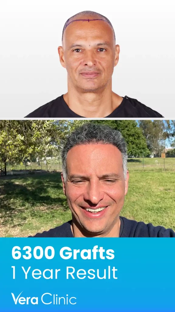 Hair Transplant Success Rate 1