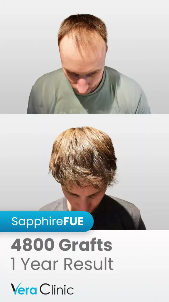 Hair Transplant Success Rate 2