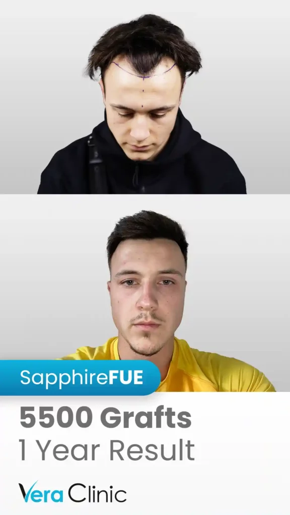 Hair Transplant Success Rate 3