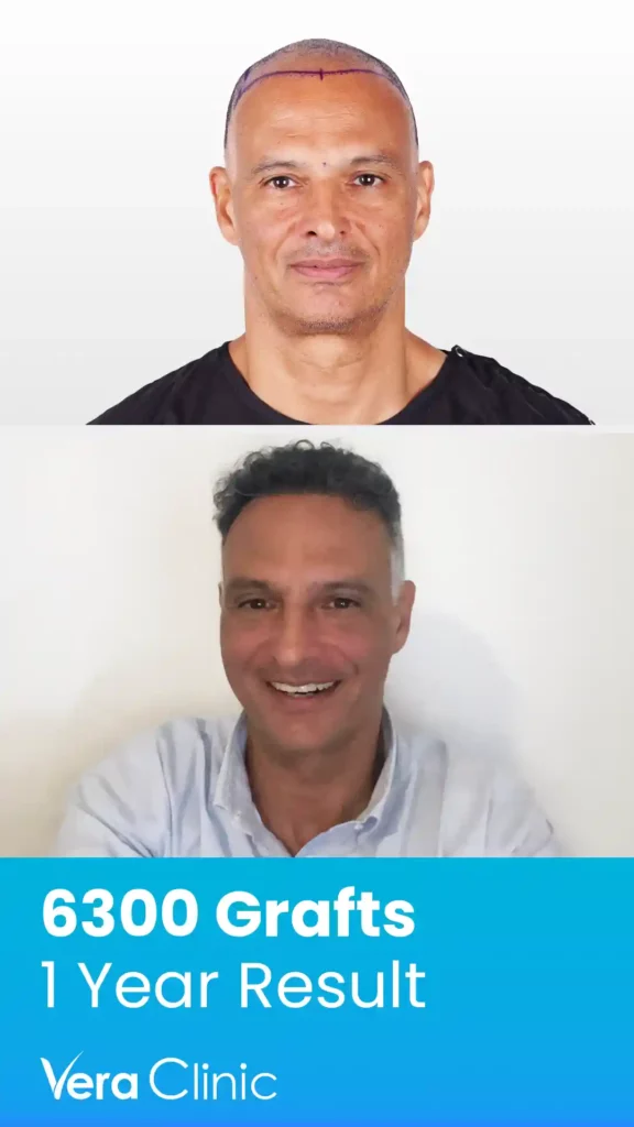 Hair Transplant Success Rate 4