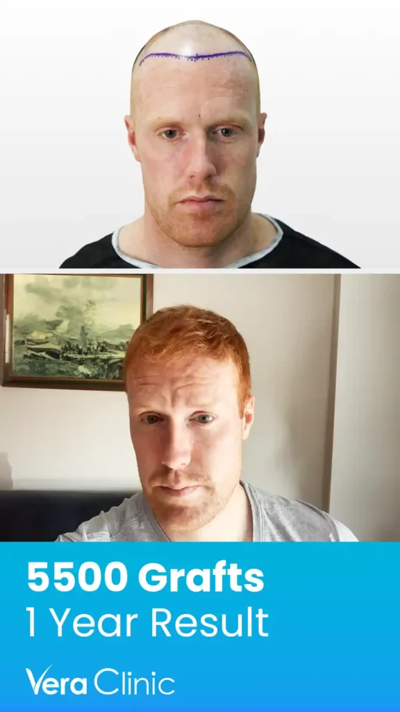 Hair Transplant Success Rate 5