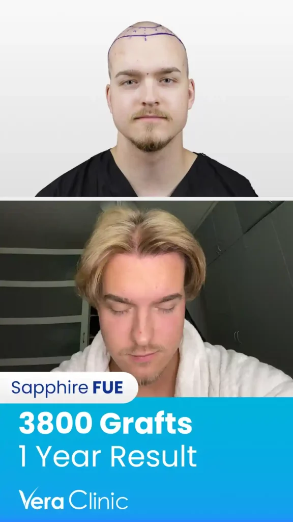 Hair Transplant Success Rate 6