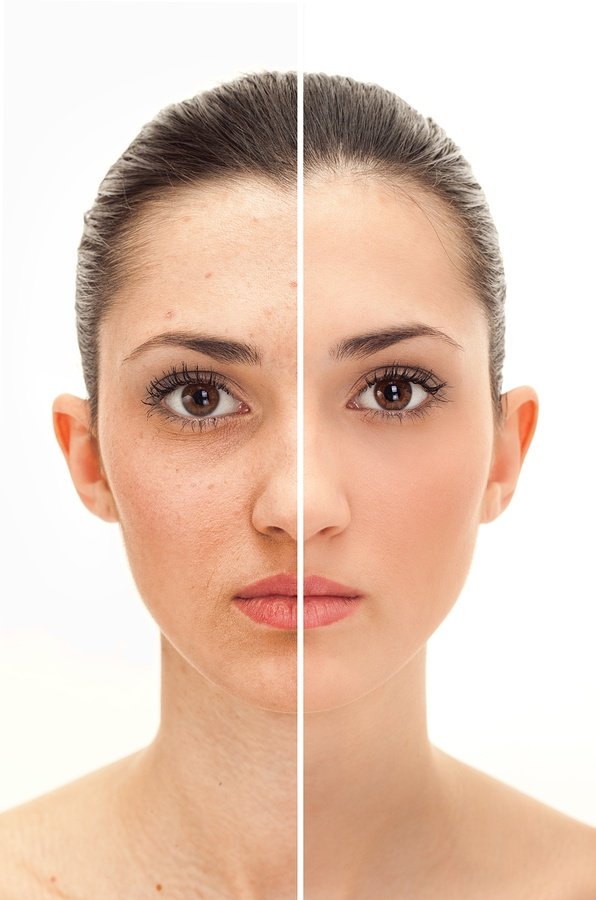 Read more about the article IPL PHOTOREJUVENATION