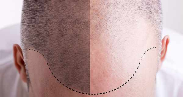 DHI Haartransplantation Vorteile Nachteile
