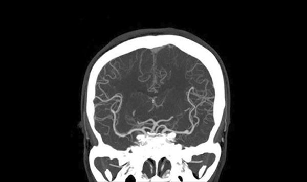 Angiotem Cerebral