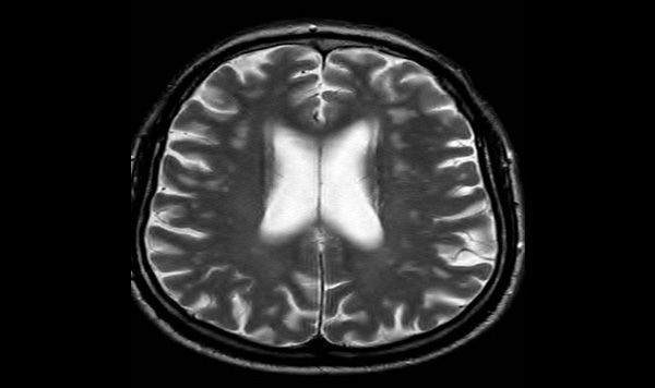 Resonancia Magnética Cerebro con contraste