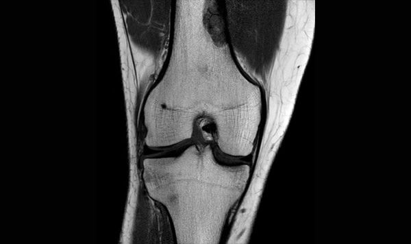 Resonancia Magnética de Rodilla con contraste