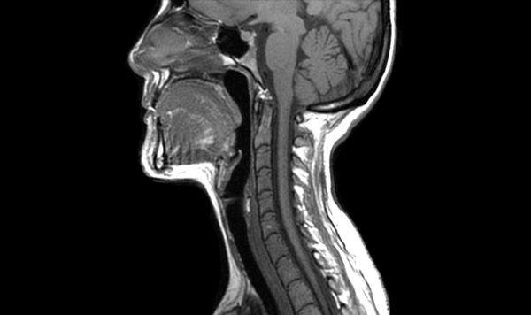 Resonancia Magnética Columna Cervical con contraste