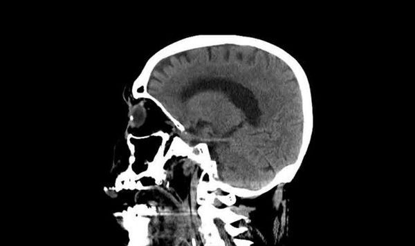 tomografía computarizada del cerebro