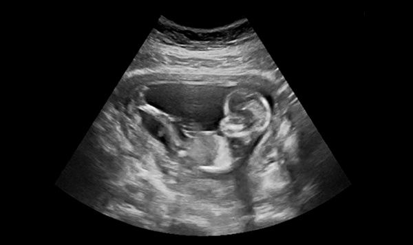 Primer Trimestre A Las Cuantas Semanas Se Hace La Ecografia