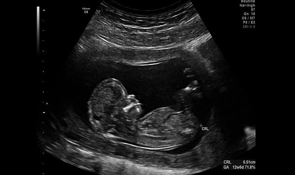 Saco Gestacional En Semanas Se Puede Saber Si Estas Embarazada