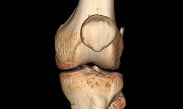 Tomografía de Rodilla con contraste
