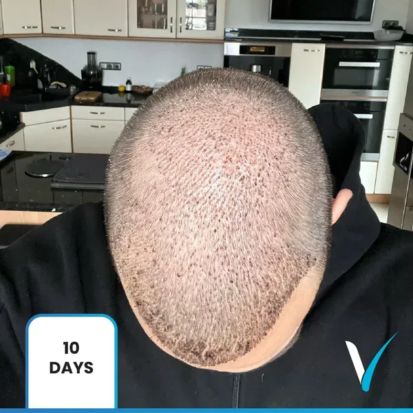 Ergebnisse einer Haartransplantation nach 2 Monaten in der Vera Clinic, Türkei, die ein langsames Nachwachsen und eine sichtbare Erholungsphase der Kopfhaut zeigen.