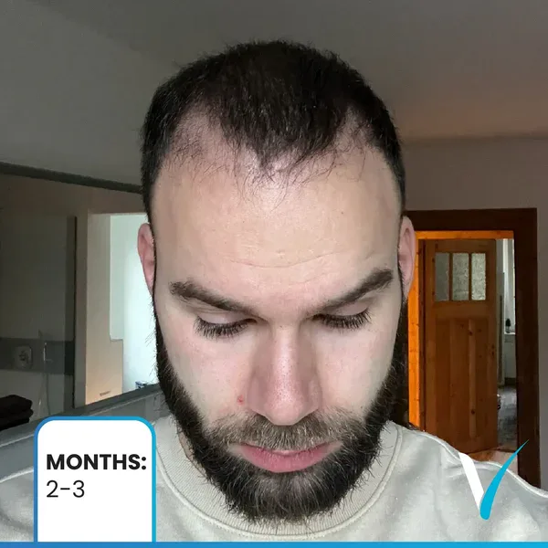 Haartransplantation nach 3 Monaten – Bilder zeigen erstes neues Haarwachstum und verbesserte Textur in der Vera Clinic, Istanbul