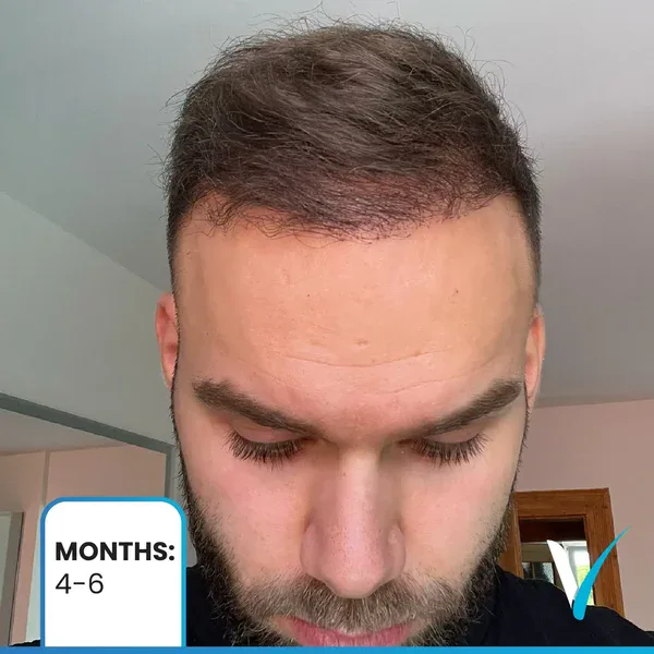 Haartransplantation nach 4 Monaten – Bilder aus der Vera Clinic in Istanbul, Türkei, zeigen dickere Strähnen und eine frühe Dichteentwicklung.