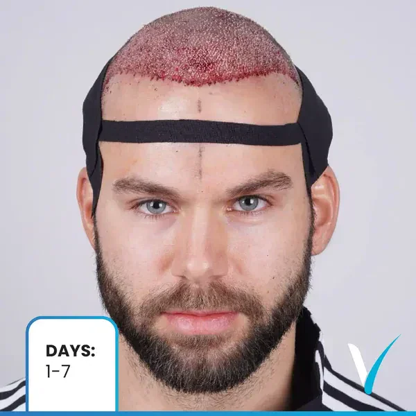 Haartransplantation 1 Monat nach der ersten Heilungsphase und dem anfänglichen Haarausfallprozess in der Vera Clinic, Istanbul