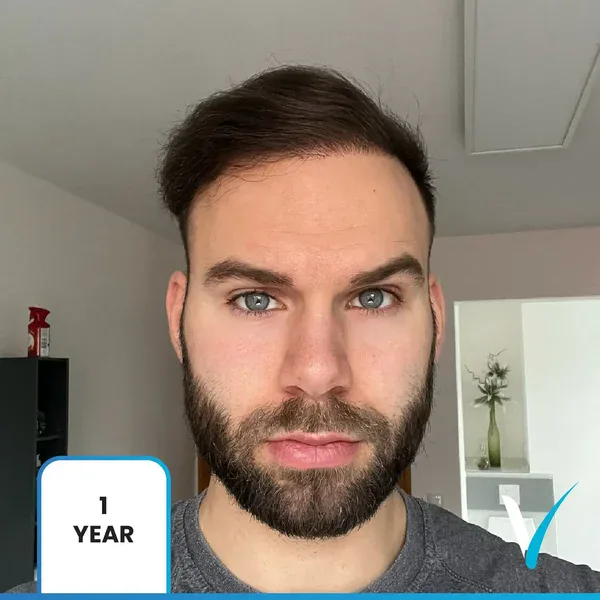 Haartransplantation Jahre später: Ergebnisse zeigen langfristiges natürliches Wachstum und stabile Dichte in der Türkei, Vera Clinic