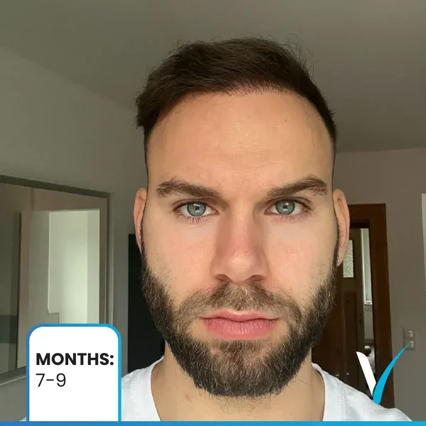 5 Monate nach der Haartransplantation keine Dichte, Übergang zu den 6-Monats-Ergebnissen, die ein progressives Wachstum und eine progressive Abdeckung bei der Vera Clinic zeigen.