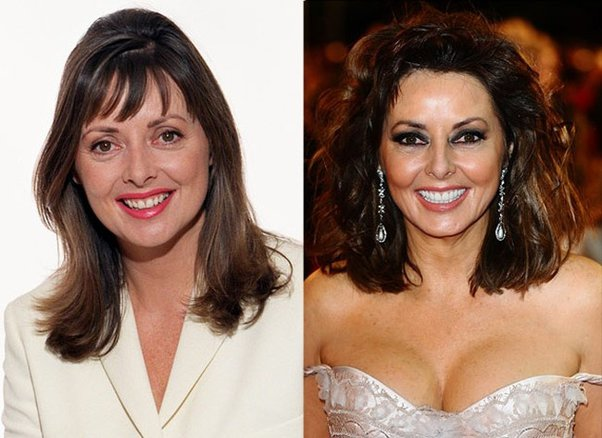 Carol Vorderman Before Plastic Surgery