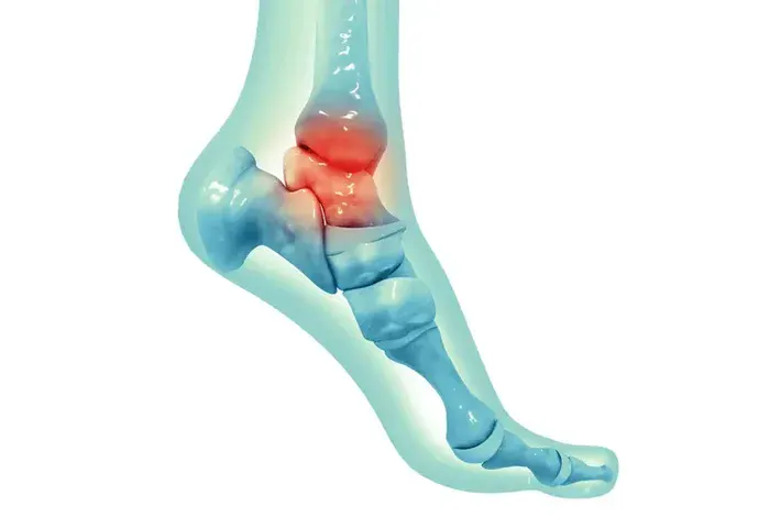 Lesão Osteocondral do tálus ou Lesão da Cartilagem