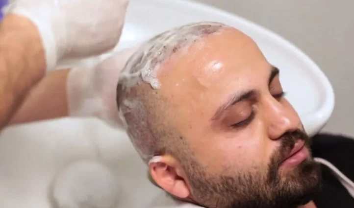 Haartransplantation Haare