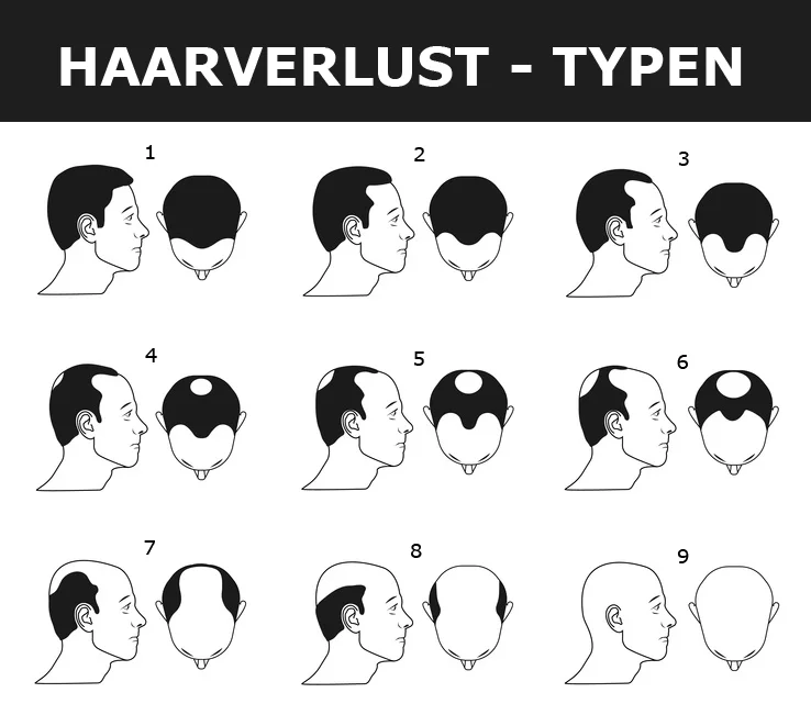 Haartransplantation 5000 Grafts