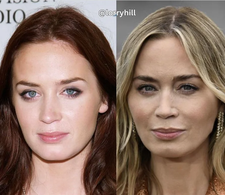 Emily Blunt Cheek Filler