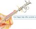 Can Viagra help after prostate surgery
