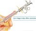 Can Viagra help after prostate surgery