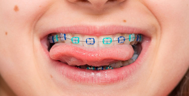 Perbedaan behel fashion dan behel perawatan, Sumber: texasortho.org