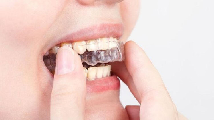 Gunakan mouth guard untuk melindungi gigi, Sumber: klikdokter.com