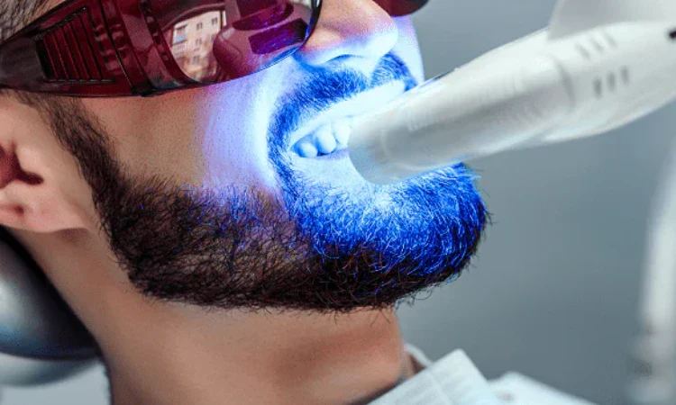 Bleaching gigi, Sumber: natrusmile.com