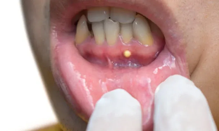 Penyebab gusi bernanah, Sumber: axeldental.id