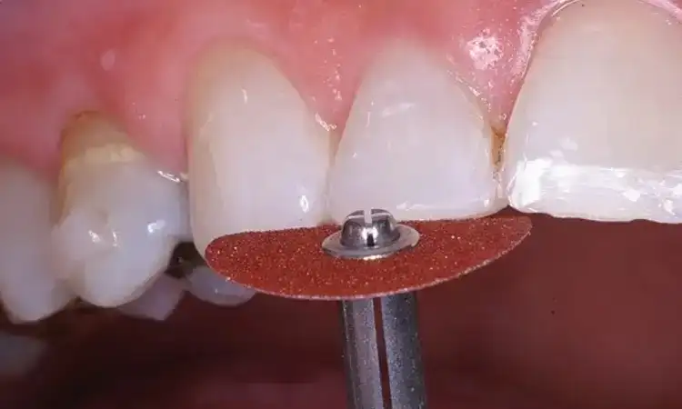 Tindakan mengikiri gigi, Sumber: folsomfamilydentistry.com