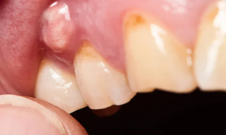Abses gusi, Sumber: winniefamilydental.com