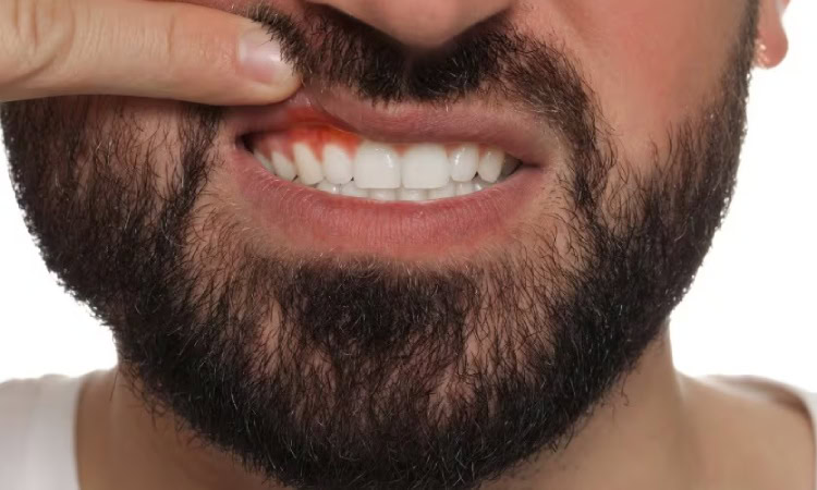 Penyebab gusi jadi hitam, Sumber: colgate.com